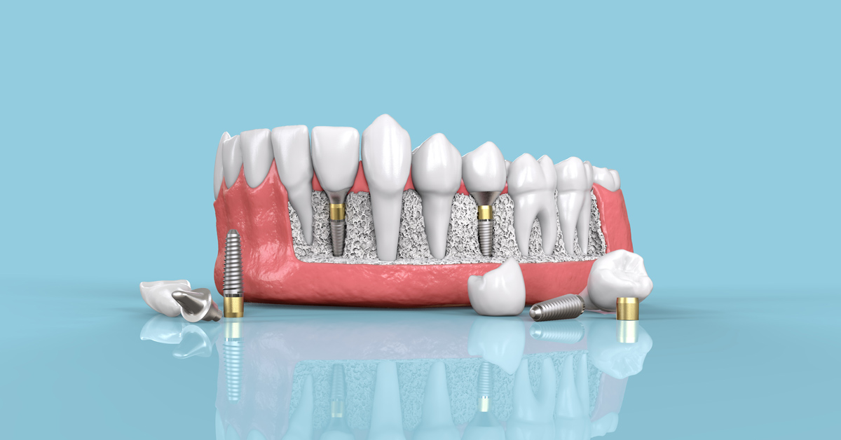 W&H Osstell Beacon | Dental equipment | ISQ Dental equipment | ISQ diagonostic technology | Dental equipment australia
