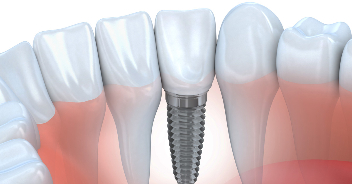 implantmed-dental-depot-LR