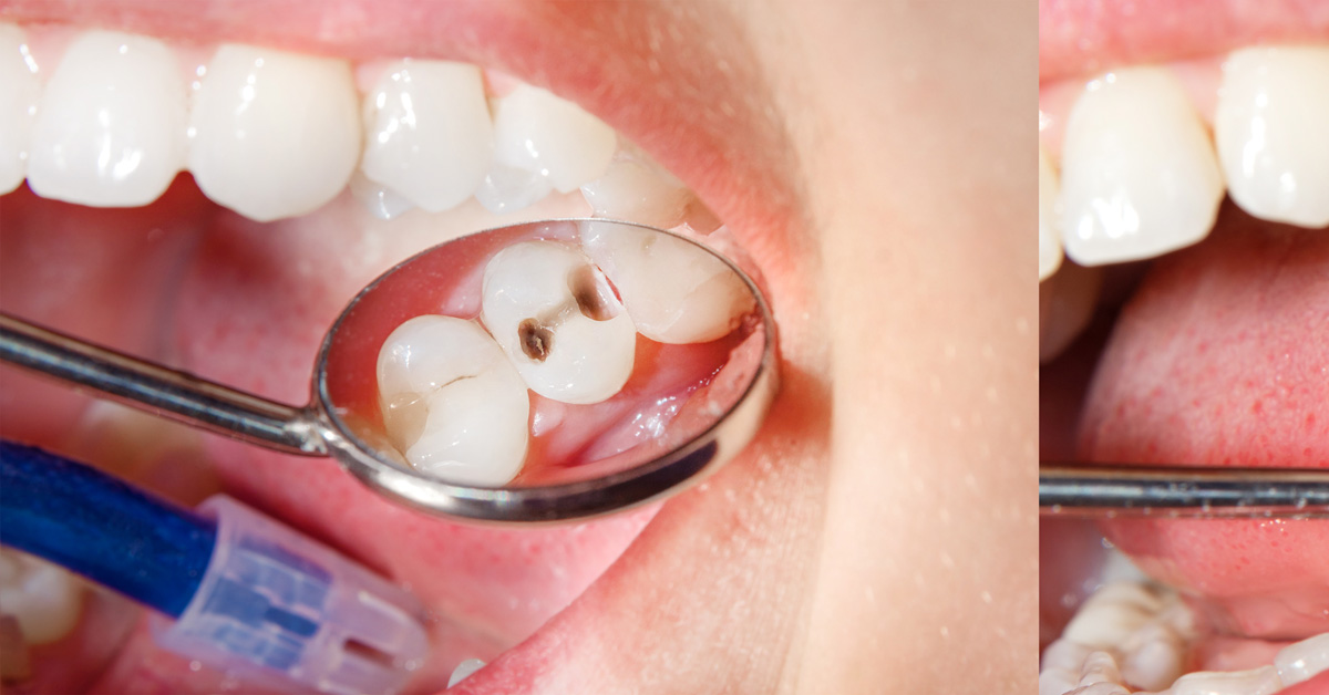 dental-depot-cavity-tooth-care