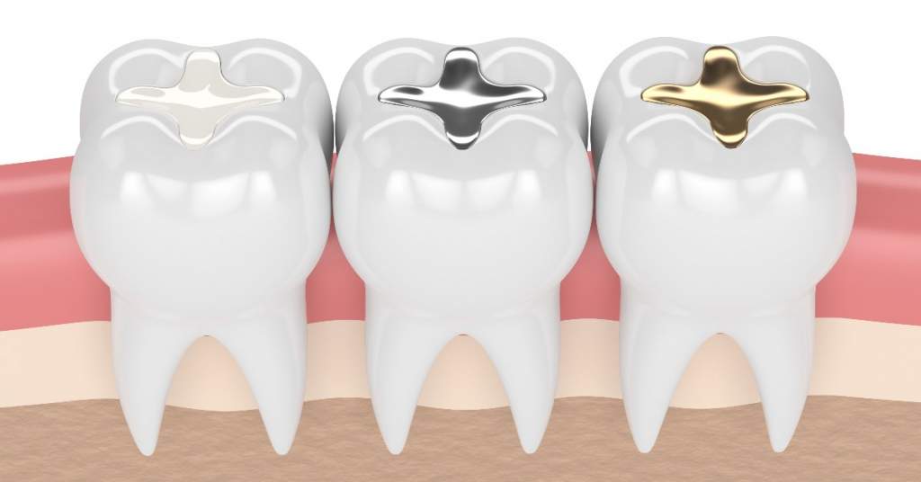 Graphic of metal filling options. Gold fillings, silver fillings. 